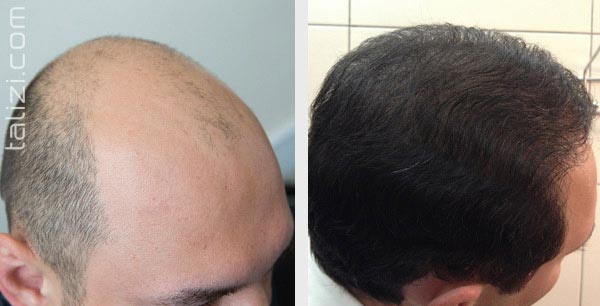 progres_hair_transplant_16.jpg