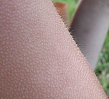 220px_2003_09_17_Goose_bumps.jpg