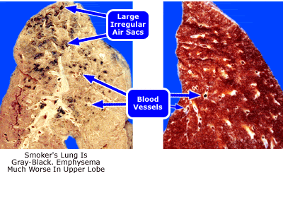 Lung_4_01_smokers_over.gif