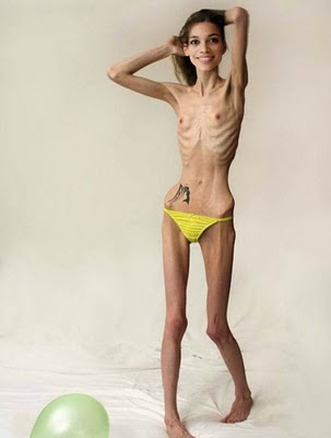 anorexia.jpg