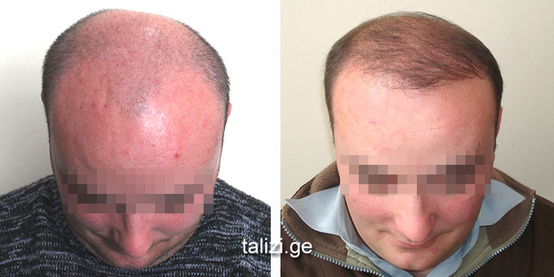 norwood_class_5_hair_transplant_2500_2.jpg