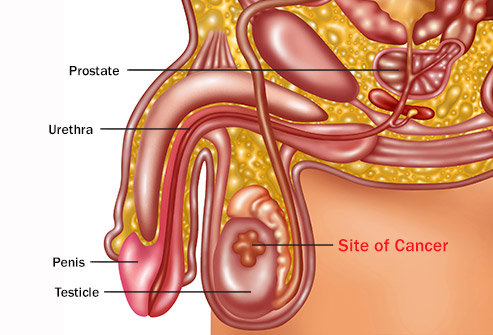 493ss_science_source_rm_testicular_cancer_illustration.jpg