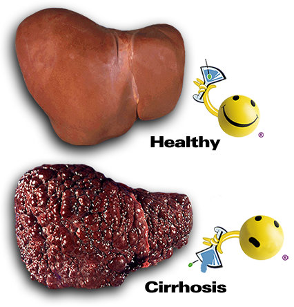 cirrhosis1.jpg