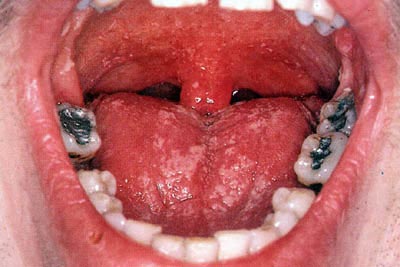 oral_thrush_infection.jpg