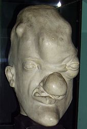 170px_Tertiary_syphilis_head.JPG
