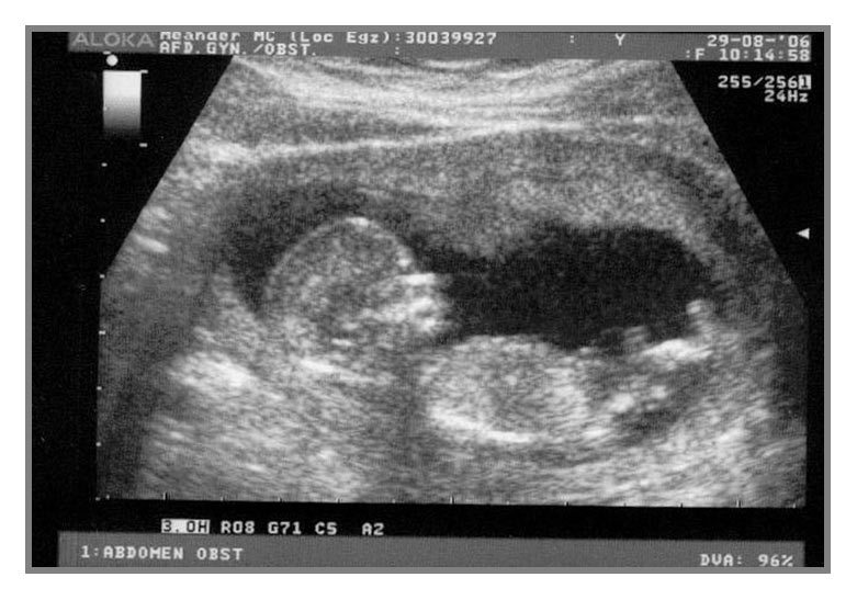 baby_3e_echo_12_wk_4_dgn.jpg