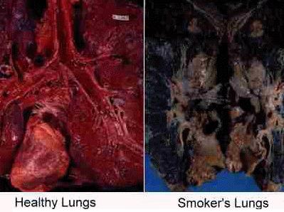 smokers_lungs.jpg