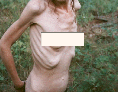 anorexia2.gif