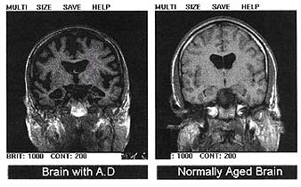 Alzheimer_27s_disease___MRI.jpg