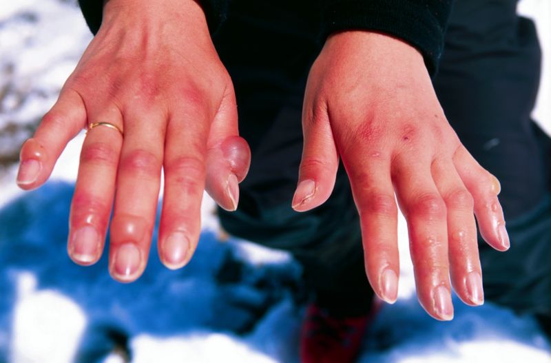 800px_Frostbitten_hands.jpg