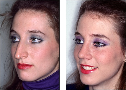 rhinoplasty_5419922821m.jpg