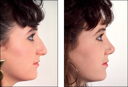 rhinoplasty_481831455m.jpg