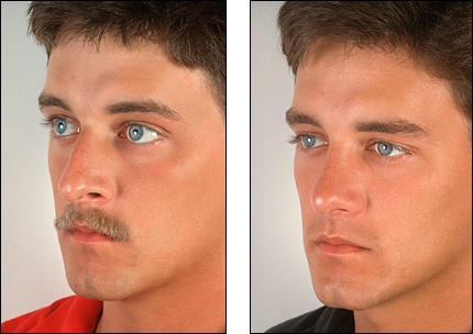 rhinoplasty_5355513100m.jpg