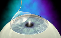 lasik_desc.jpg