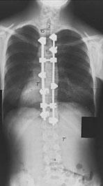 postop_xray_275_bdy.jpg