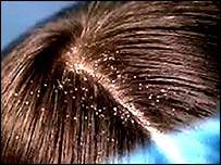 dandruff.jpg