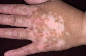 vitiligo1.jpg