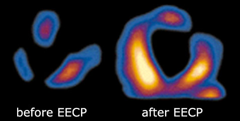 EECP_before_and_after.jpg