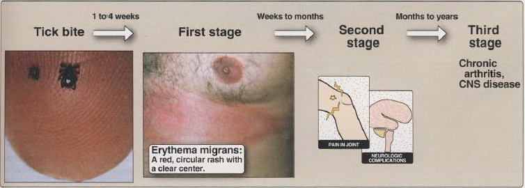 lyme.jpg