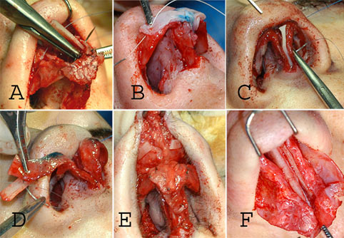 rinoplastiaestetica_fig1.jpg