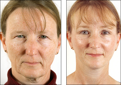 face_lift_4809391627m.jpg
