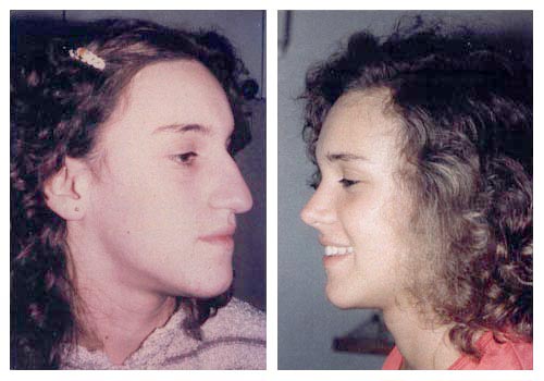 res_rinoplastia22.jpg