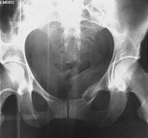 pelvis1.jpg