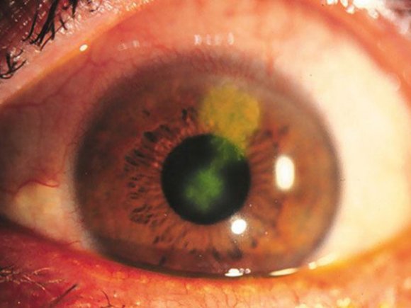 HerpesSimplexKeratitis.jpg