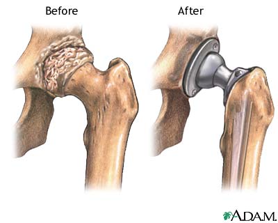 rheumatoidhipreplace.jpg