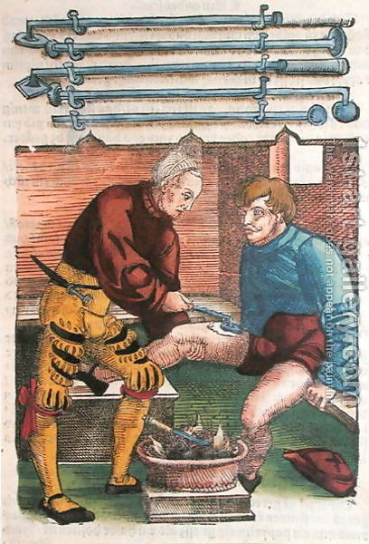 Cauterisation__Illustration_From_Feldtbuch_Der_Wundartzney_By_Hans_Von_Gersdorff__C.1540.jpg
