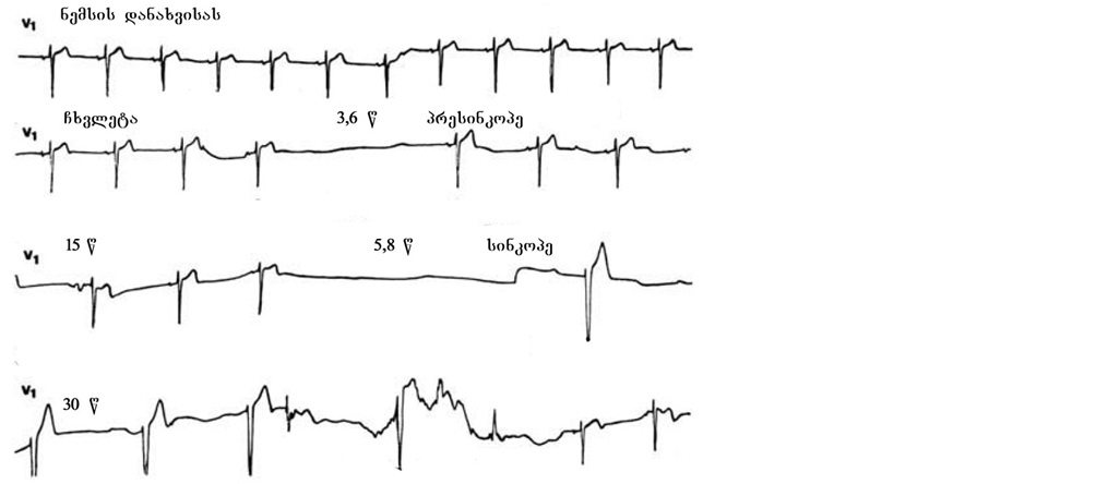 VV_syncope.jpg