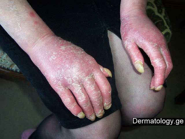 psoriazuli_oniqogrifozi_da_artropatia1.jpg