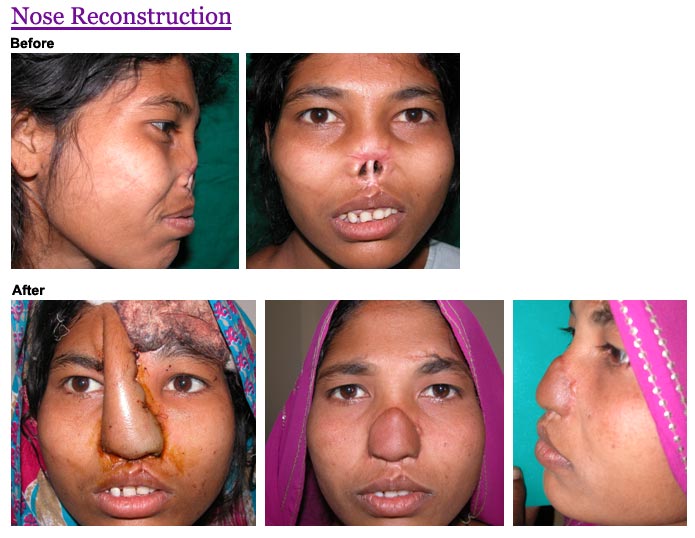 nose_reconstruction03.jpg