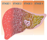 hcv_liver_stages_01.jpg