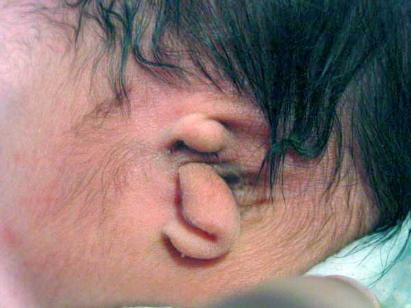 microtia.jpg