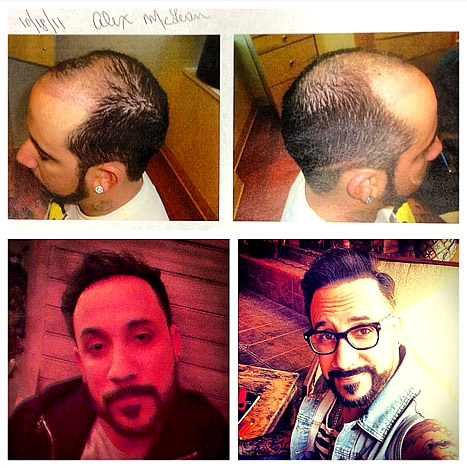 backstreet_boysy_aj_mclean_hair_transplant_2013.jpg