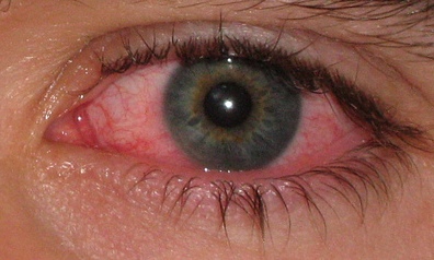 pink_eye2.jpg