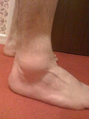 Foot_and_Ankle_Swelling_Causes.jpg
