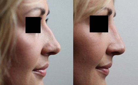 nose.jpg