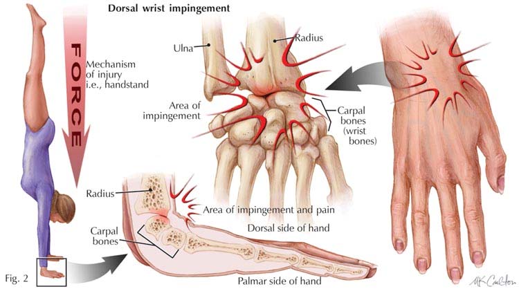 crossfit_wrist_injuries.jpg
