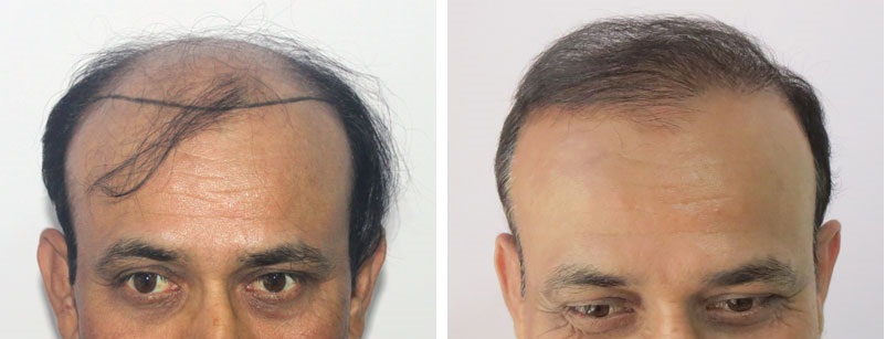 norwood_class_7_hair_transplant_2500_1.jpg