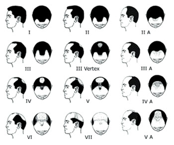 androgenetic_alopecia_02.jpg