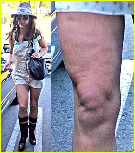 britney_spears_leg_dimpling.jpg