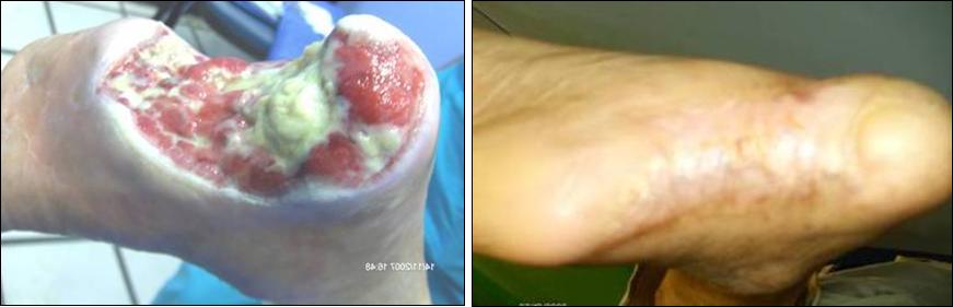 gangrena_del_pie_en_diabetico1.jpg