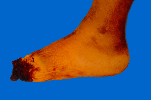 gangrena.jpg