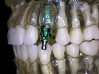 implant_5.jpg