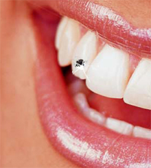 DecoDent_Teeth_Jewel_.jpg
