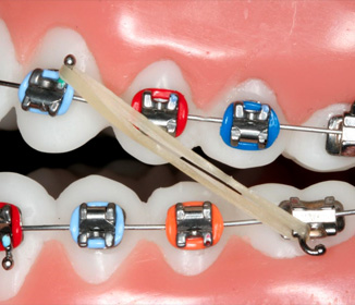 Colorful_inter_arch_rubber_band_on_braces.jpg