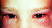 Allergic_conjunctivitis.jpg