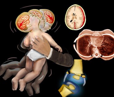 thmb_43ce0fd312babshaken_infant5.jpg